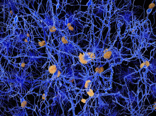 Read: After Decades of Disappointment, a Turning Point Is Visible in Alzheimer’s Treatment